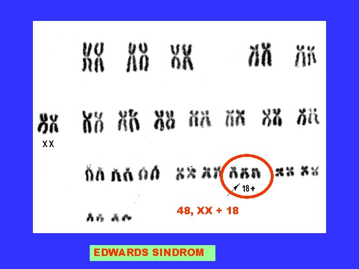 48, XX + 18 EDWARDS SINDROM 