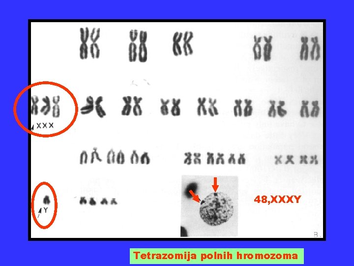 48, XXXY Tetrazomija polnih hromozoma 