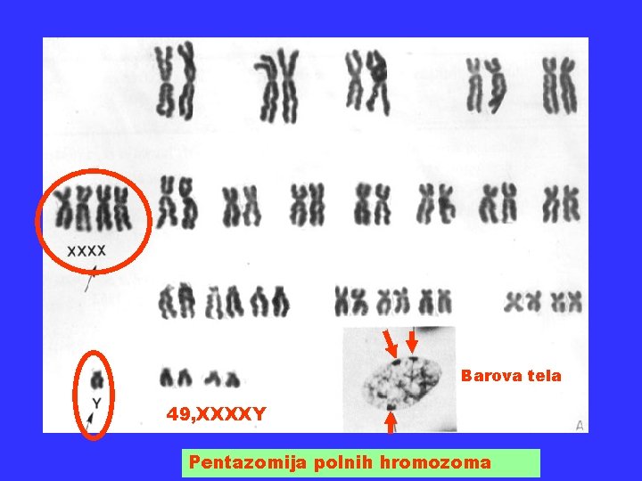 Barova tela 49, XXXXY Pentazomija polnih hromozoma 