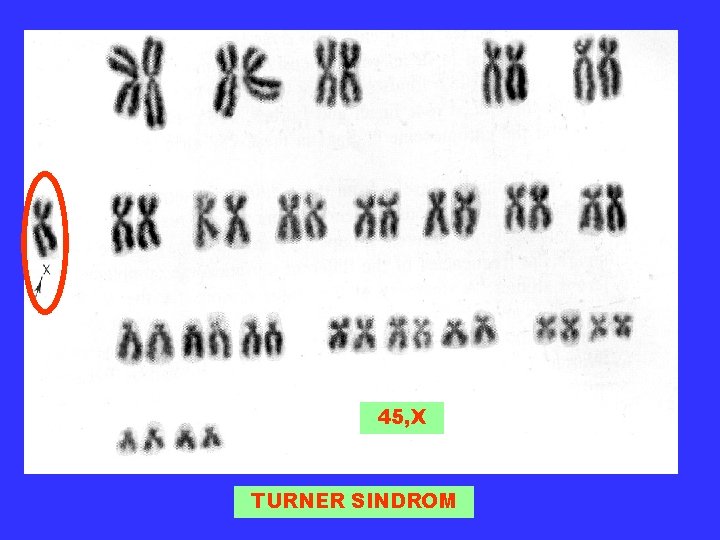 45, X TURNER SINDROM 