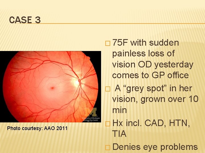 CASE 3 � 75 F Photo courtesy: AAO 2011 with sudden painless loss of