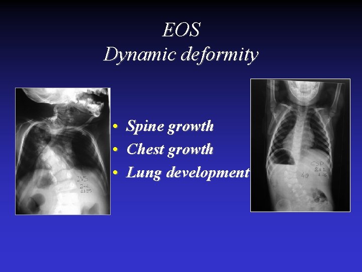 EOS Dynamic deformity • • • Spine growth Chest growth Lung development 