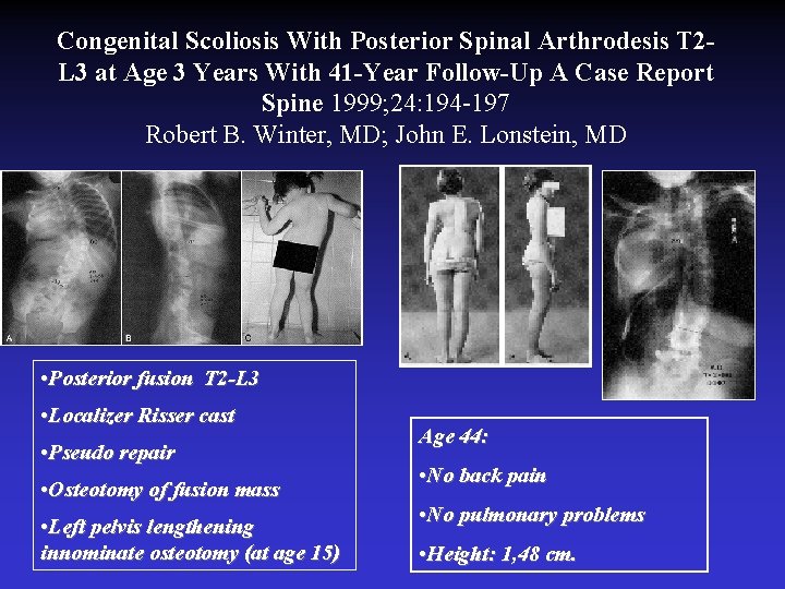 Congenital Scoliosis With Posterior Spinal Arthrodesis T 2 L 3 at Age 3 Years