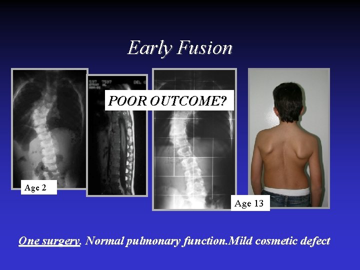 Early Fusion POOR OUTCOME? Age 2 Age 13 One surgery. Normal pulmonary function. Mild