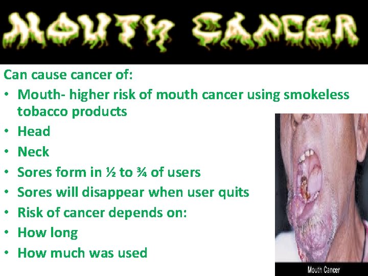 Can cause cancer of: • Mouth- higher risk of mouth cancer using smokeless tobacco