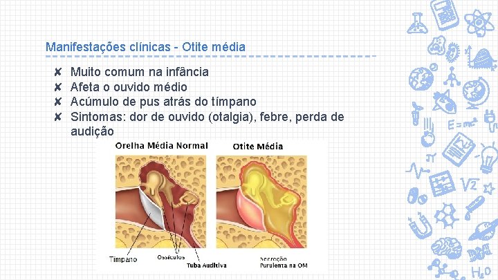 Manifestações clínicas - Otite média ✘ ✘ Muito comum na infância Afeta o ouvido