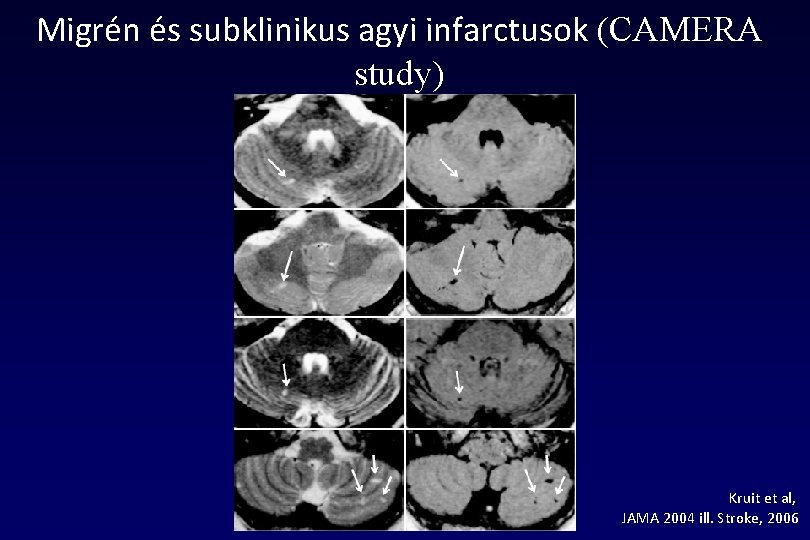 Migrén és subklinikus agyi infarctusok (CAMERA study) Kruit et al, JAMA 2004 ill. Stroke,