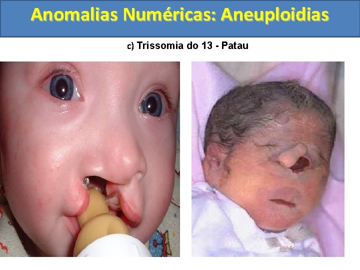 Anomalias Numéricas: Aneuploidias c) Trissomia do 13 - Patau 