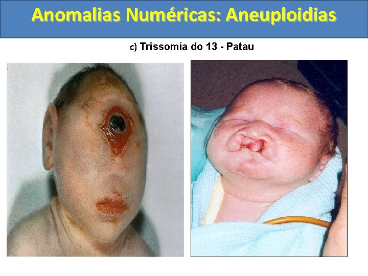 Anomalias Numéricas: Aneuploidias c) Trissomia do 13 - Patau 