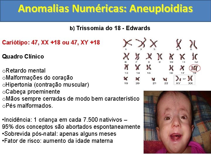 Anomalias Numéricas: Aneuploidias b) Trissomia do 18 - Edwards Cariótipo: 47, XX +18 ou