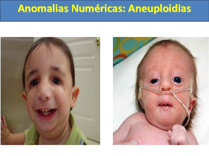 Anomalias Numéricas: Aneuploidias 