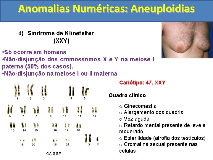 Anomalias Numéricas: Aneuploidias d) Síndrome de Klinefelter (XXY) • Só ocorre em homens •