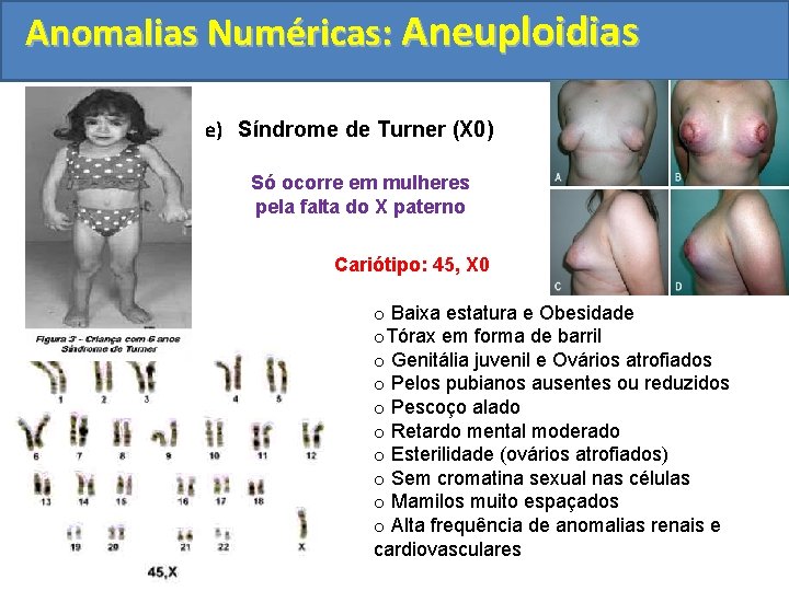 Anomalias Numéricas: Aneuploidias e) Síndrome de Turner (X 0) Só ocorre em mulheres pela