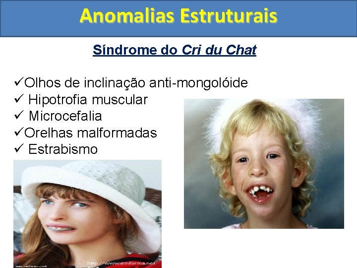 Anomalias Estruturais Síndrome do Cri du Chat üOlhos de inclinação anti-mongolóide ü Hipotrofia muscular