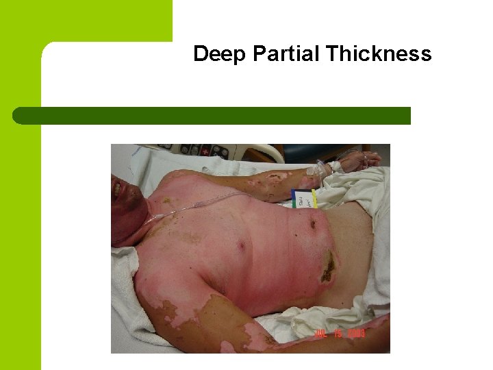 Deep Partial Thickness 