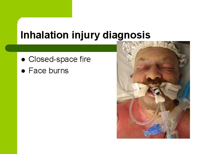 Inhalation injury diagnosis l l Closed-space fire Face burns 
