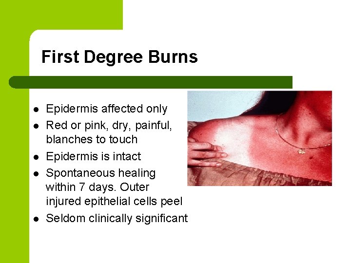 First Degree Burns l l l Epidermis affected only Red or pink, dry, painful,