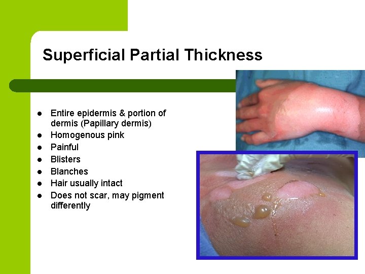 Superficial Partial Thickness l l l l Entire epidermis & portion of dermis (Papillary