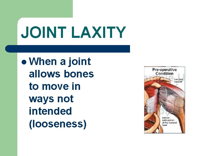 JOINT LAXITY l When a joint allows bones to move in ways not intended