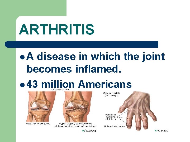 ARTHRITIS l. A disease in which the joint becomes inflamed. l 43 million Americans