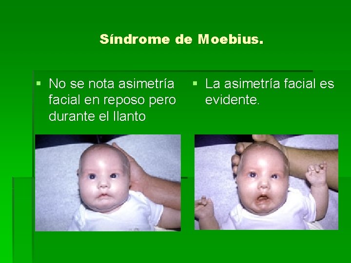 Síndrome de Moebius. § No se nota asimetría facial en reposo pero durante el Síndrome de Moebius. § No se nota asimetría facial en reposo pero durante el