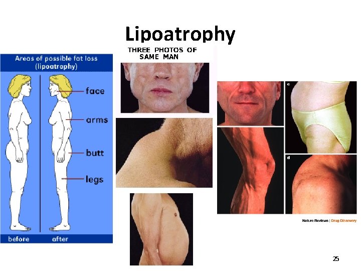 Lipoatrophy 25 