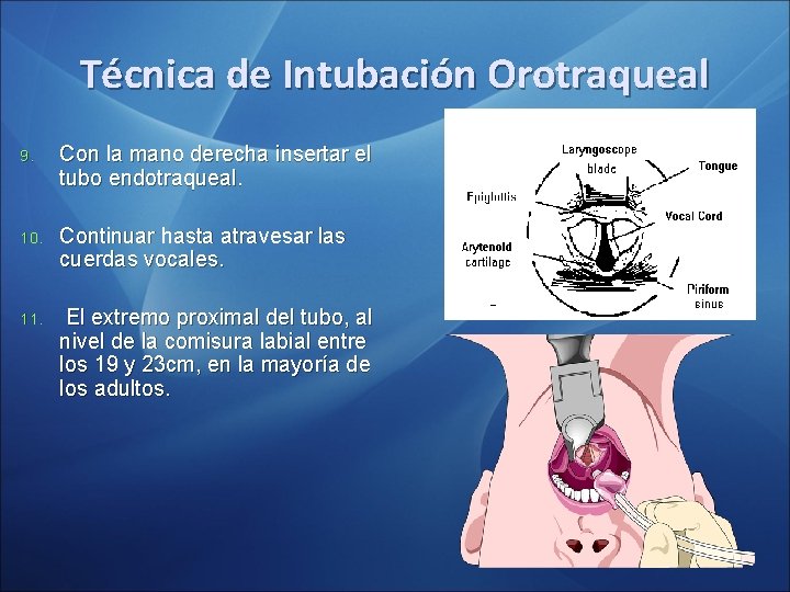 Técnica de Intubación Orotraqueal 9. Con la mano derecha insertar el tubo endotraqueal. 10. Técnica de Intubación Orotraqueal 9. Con la mano derecha insertar el tubo endotraqueal. 10.