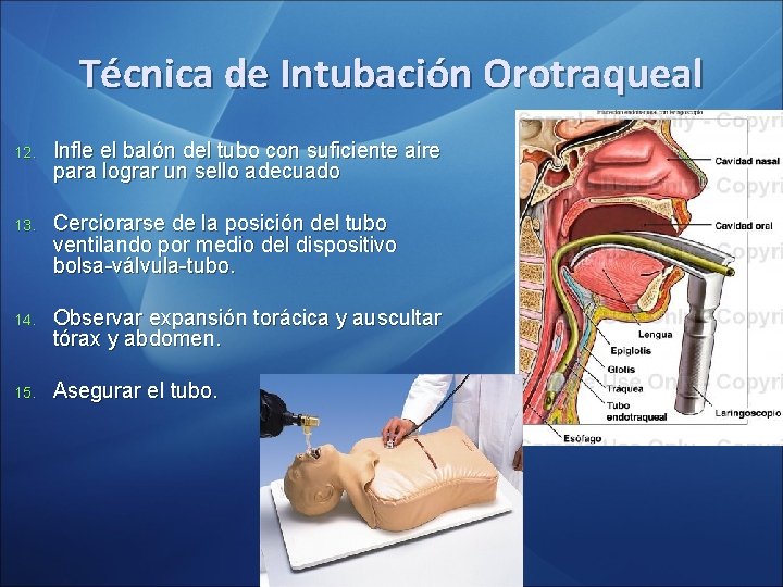 Técnica de Intubación Orotraqueal 12. Infle el balón del tubo con suficiente aire para