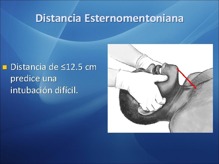Distancia Esternomentoniana n Distancia de ≤ 12. 5 cm predice una intubación difícil. Distancia Esternomentoniana n Distancia de ≤ 12. 5 cm predice una intubación difícil.