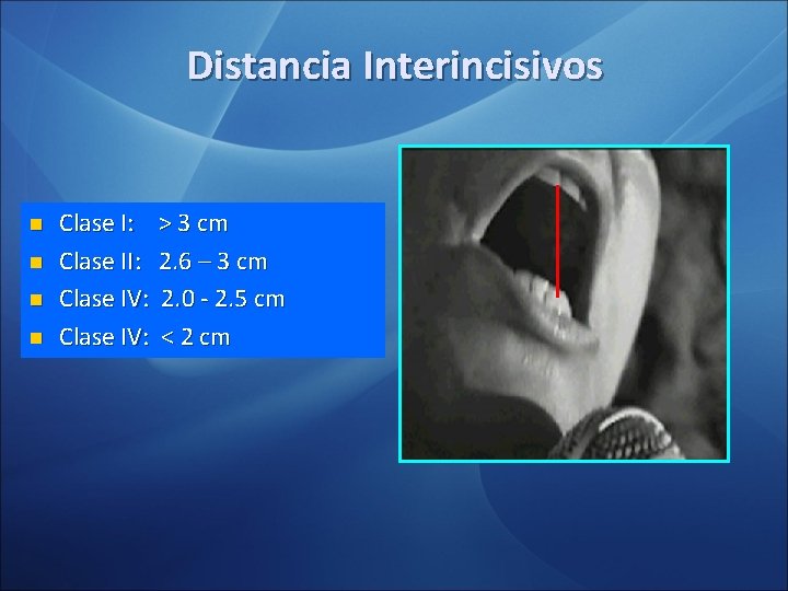 Distancia Interincisivos n n Clase I: > 3 cm Clase II: 2. 6 –