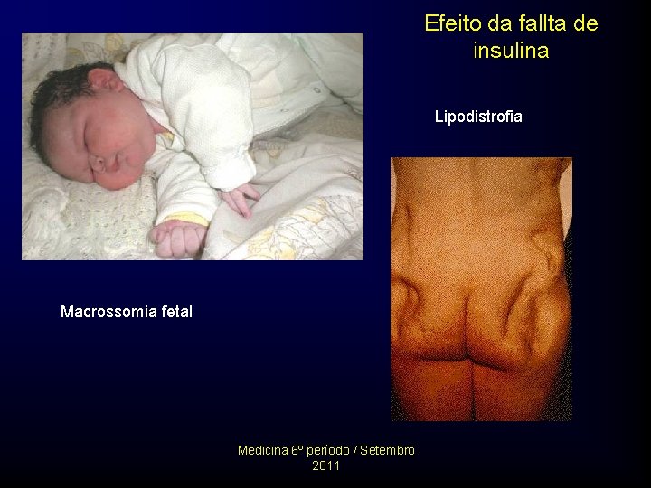 Efeito da fallta de insulina Lipodistrofia Macrossomia fetal Medicina 6º período / Setembro 2011