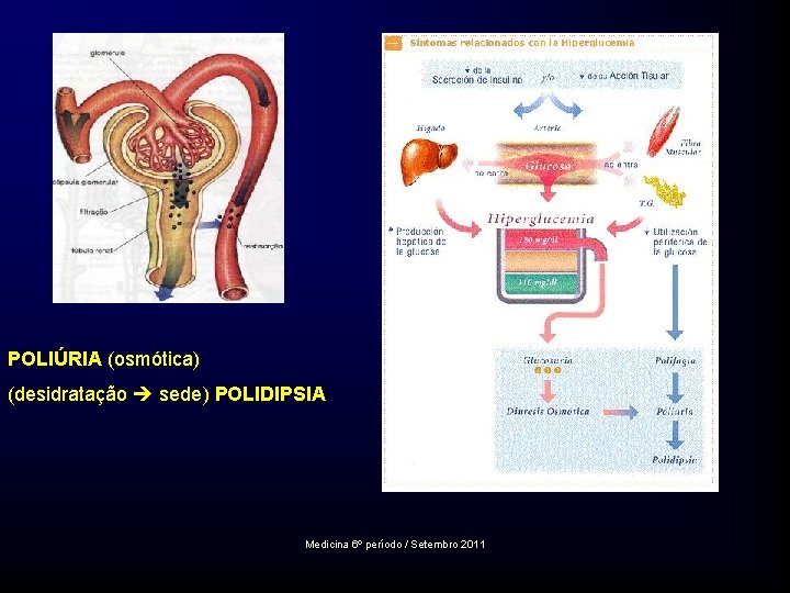 POLIÚRIA (osmótica) (desidratação sede) POLIDIPSIA Medicina 6º período / Setembro 2011 