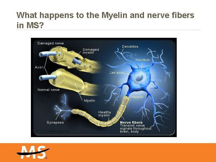 What happens to the Myelin and nerve fibers in MS? 