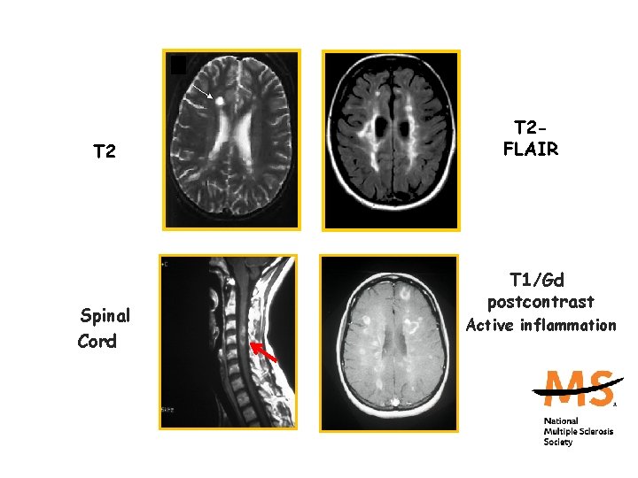MRI Findings in MS T 2 Spinal Cord T 2 FLAIR T 1/Gd postcontrast