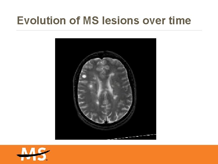 Evolution of MS lesions over time 