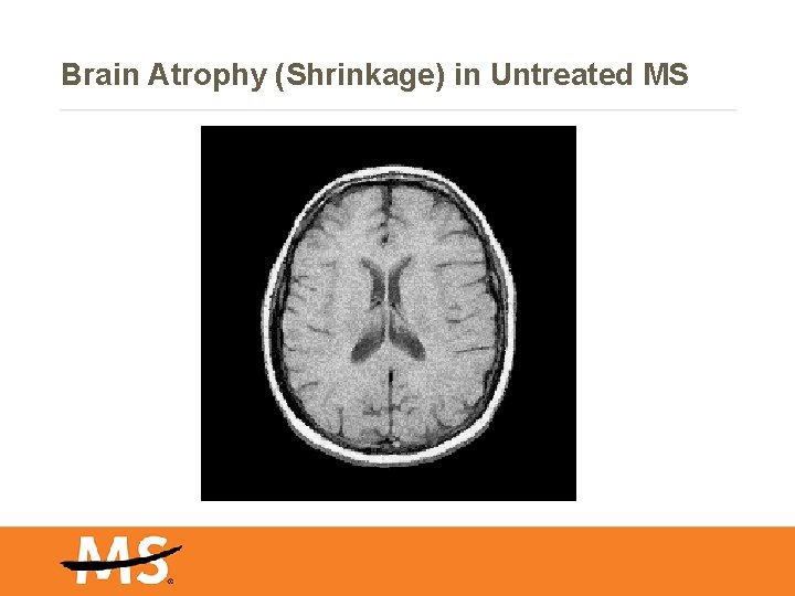 Brain Atrophy (Shrinkage) in Untreated MS 