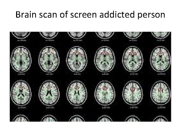 Brain scan of screen addicted person 