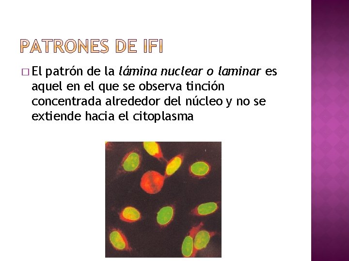 � El patrón de la lámina nuclear o laminar es aquel en el que