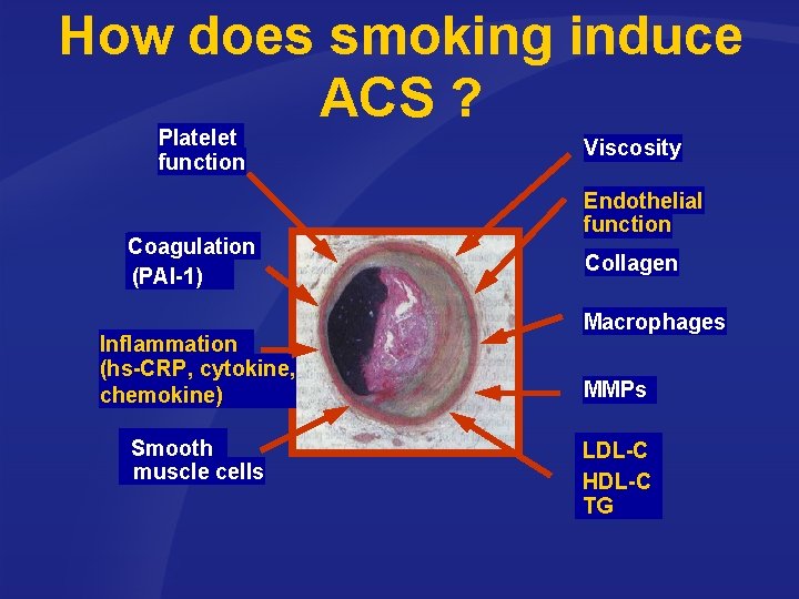 How does smoking induce ACS ? Platelet function Coagulation (PAI-1) Inflammation (hs-CRP, cytokine, chemokine)