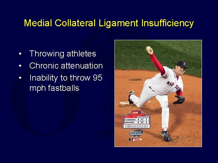 Medial Collateral Ligament Insufficiency • Throwing athletes • Chronic attenuation • Inability to throw