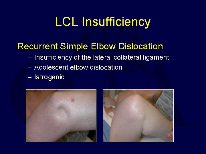 LCL Insufficiency Recurrent Simple Elbow Dislocation – Insufficiency of the lateral collateral ligament –