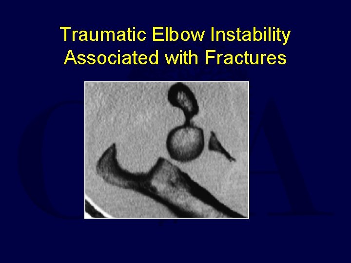 Traumatic Elbow Instability Associated with Fractures 