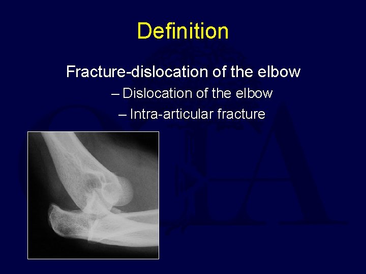 Definition Fracture-dislocation of the elbow – Dislocation of the elbow – Intra-articular fracture 