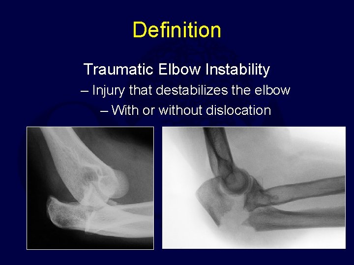 Definition Traumatic Elbow Instability – Injury that destabilizes the elbow – With or without