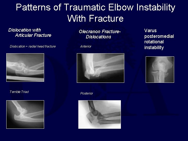 Patterns of Traumatic Elbow Instability With Fracture Dislocation with Articular Fracture Olecranon Fracture. Dislocations