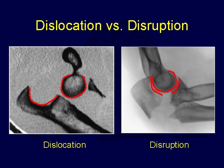 Dislocation vs. Disruption Dislocation Disruption 