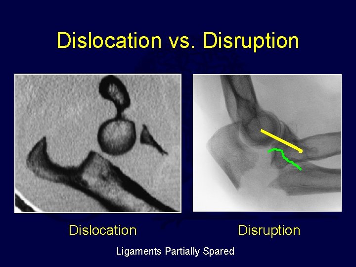Dislocation vs. Disruption Dislocation Ligaments Partially Spared Disruption 