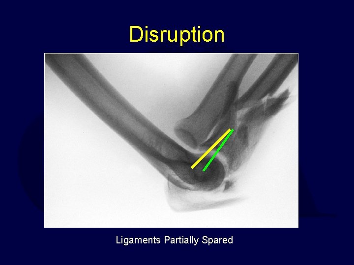 Disruption Ligaments Partially Spared 