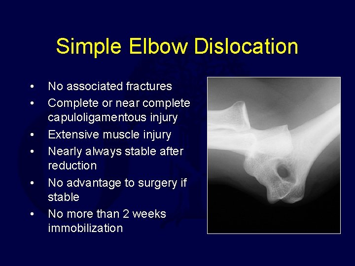 Simple Elbow Dislocation • • • No associated fractures Complete or near complete capuloligamentous