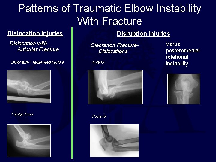 Patterns of Traumatic Elbow Instability With Fracture Dislocation Injuries Dislocation with Articular Fracture Disruption